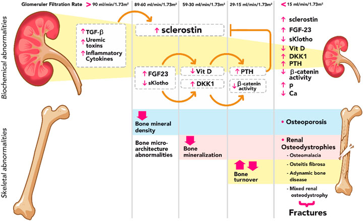 Bone markers in low and high turnover bone disease in CKD