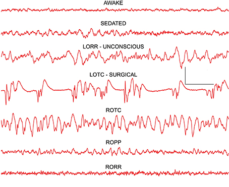 Resultado de imagen para brain consciousness anaesthesia eeg