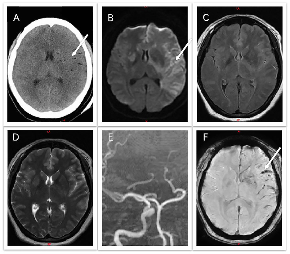 Frontiers | Case report and literature review: fatal cerebral fat