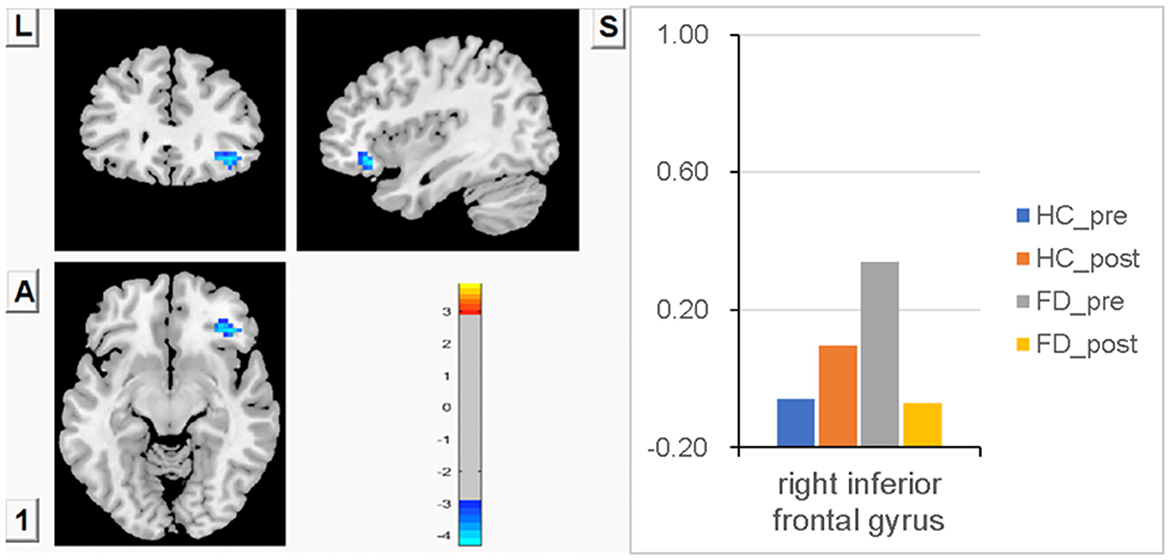 Frontiers  Differential responses from the left postcentral gyrus, right  middle frontal gyrus, and precuneus to meal ingestion in patients with  functional dyspepsia