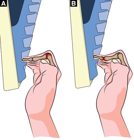 Photo showing the 28-year-old male with absence of all middle phalanges