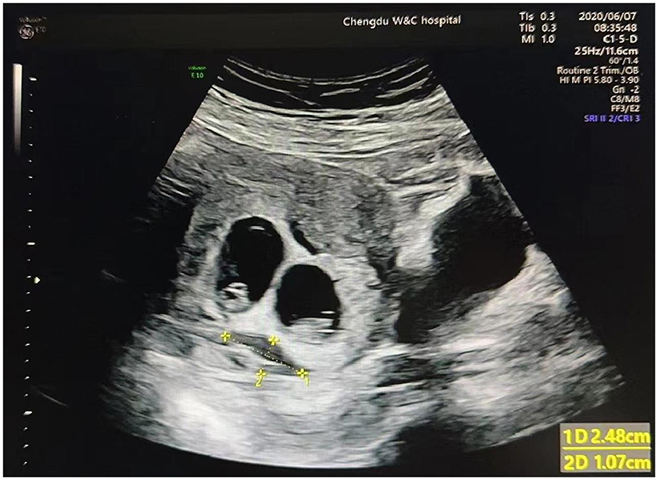 Frontiers The Risk Factors And Impact Of Subchorionic Hematoma In The