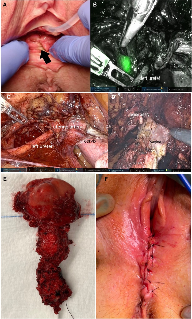 Frontiers | Case report: a robotic-vaginal approach for total ...