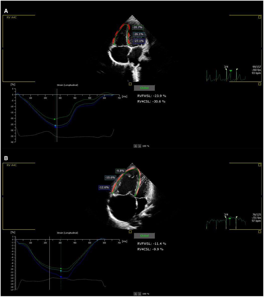 Frontiers  The Predictive Value of Right Ventricular Longitudinal Strain  in Pulmonary Hypertension, Heart Failure, and Valvular Diseases