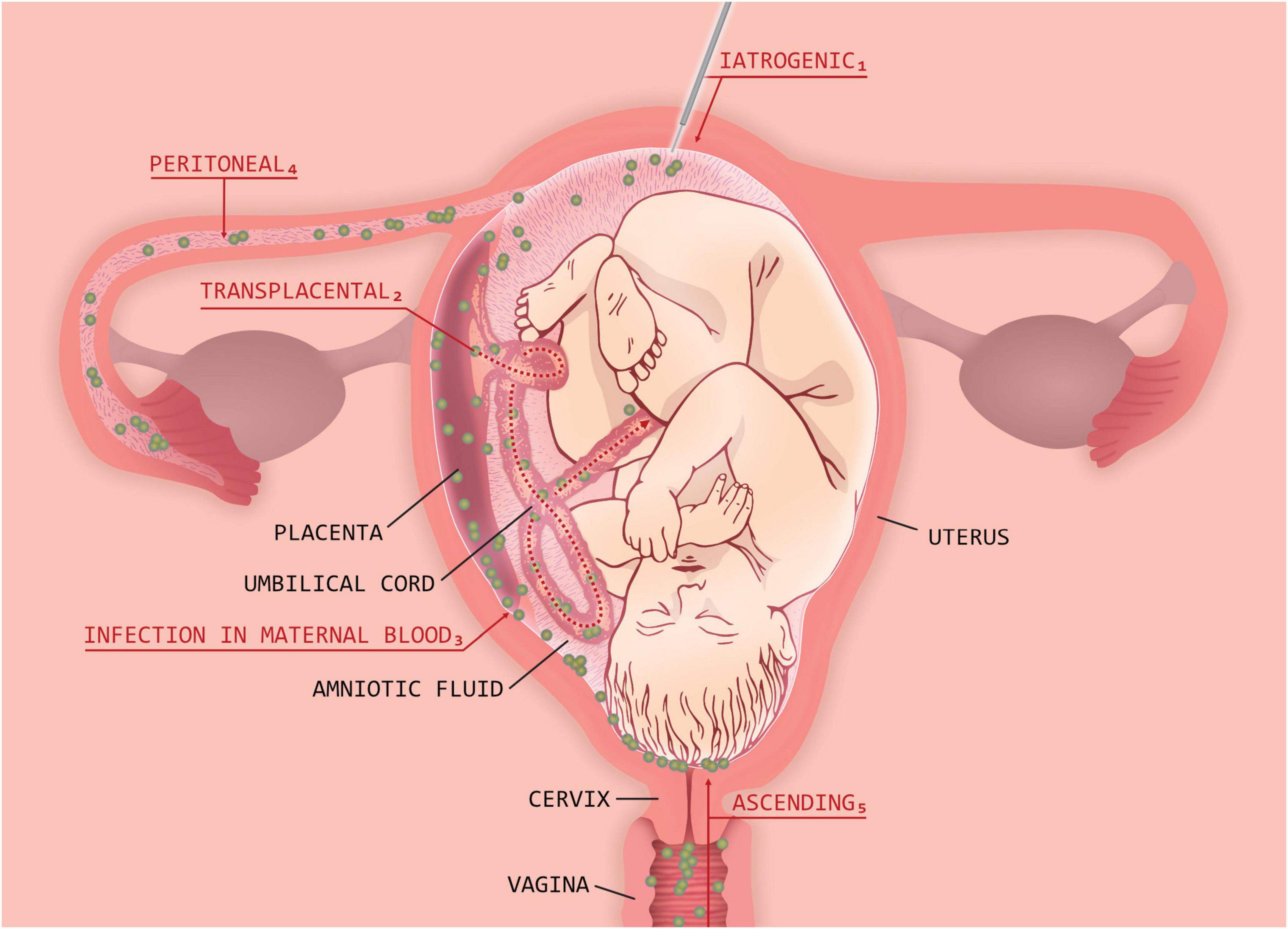 Frontiers  Clinical chorioamnionitis: where do we stand now?