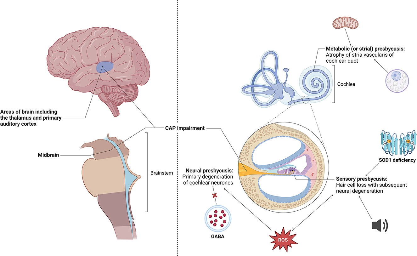 Hearing impairment is associated with cognitive decline, brain