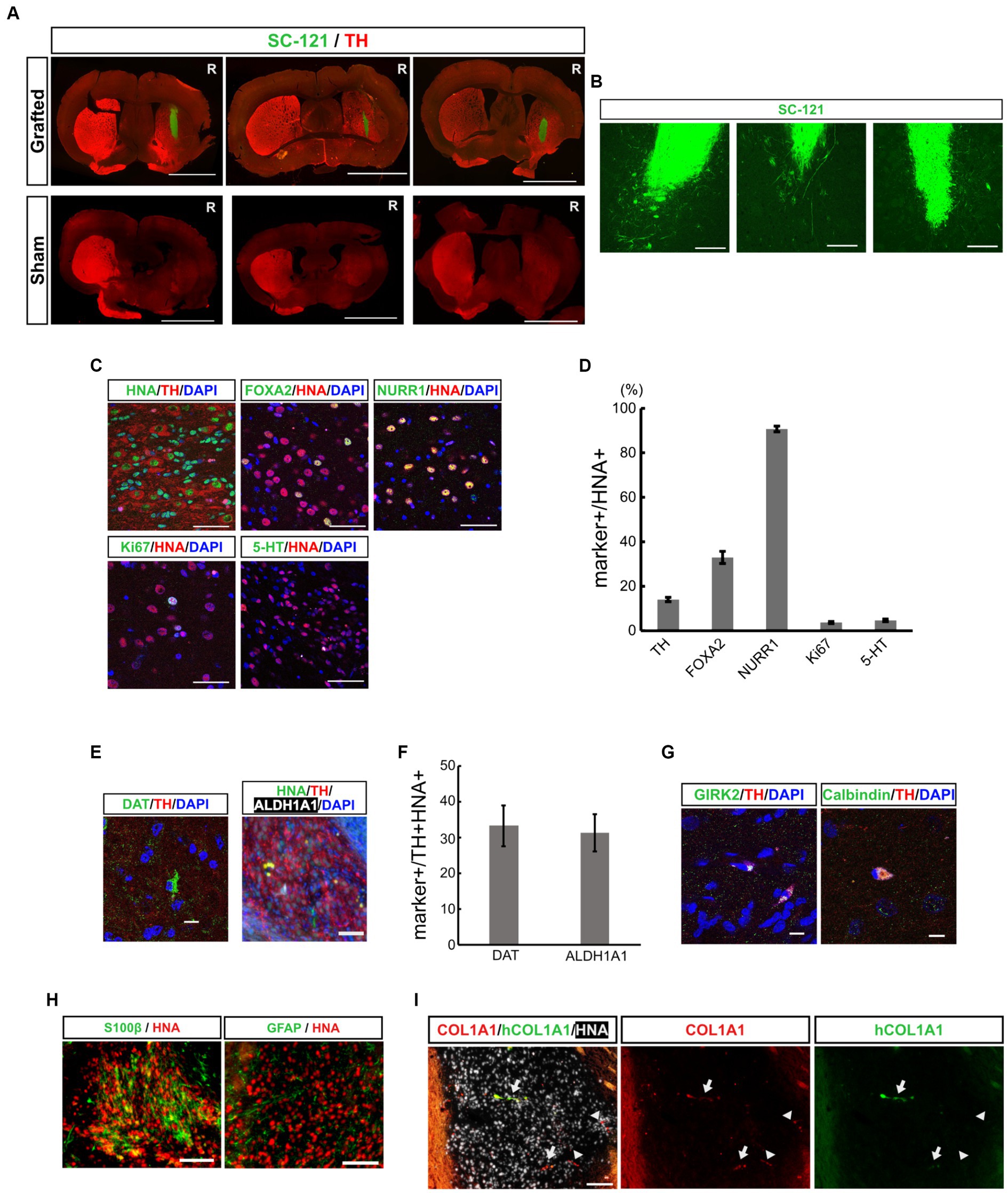 Frontiers  Intrafamilial variability in SLC6A1-related neurodevelopmental  disorders