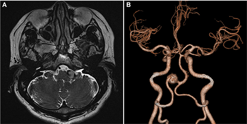 Marginal mandibular nerve, Radiology Reference Article