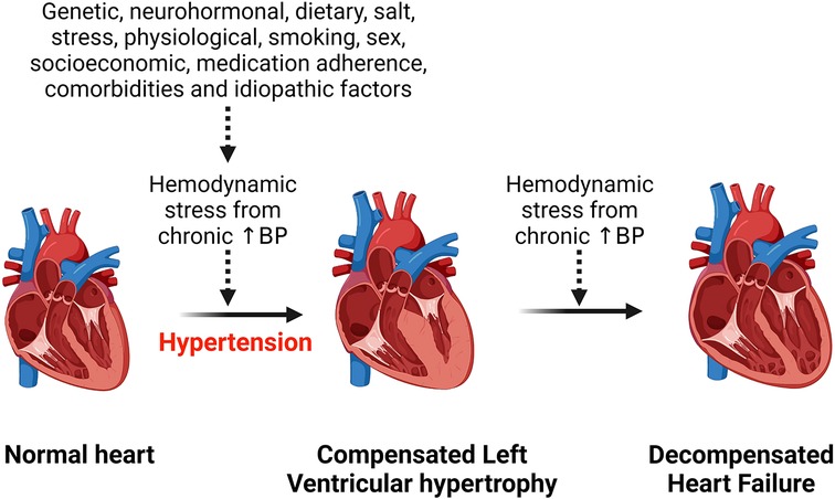 hypertrophy of the heart