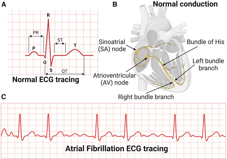 Frontiers | Hypertensive heart disease: risk factors, complications and ...