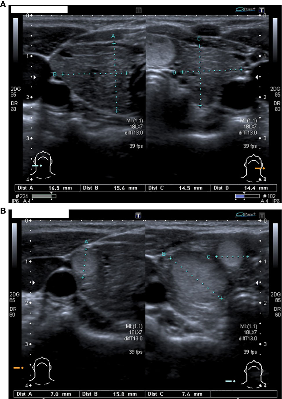 Frontiers | Case Report - Multinodular goiter in a patient with ...