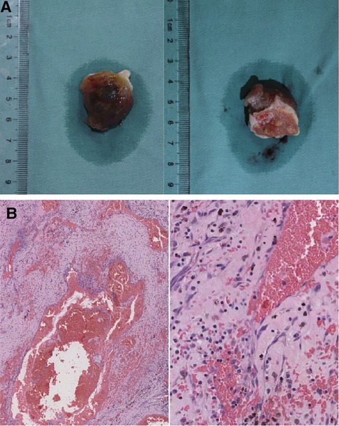 Frontiers Case Report Left Atrial Myxoma With Morphology Of