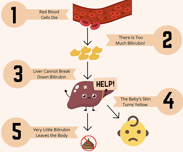 Figure 1 - Normally, when red blood cells die, the liver breaks down bilirubin so it can leave the body in our poop.