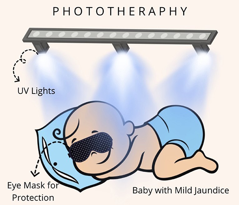 Figure 2 - One way to treat neonatal jaundice is to use UV phototherapy.