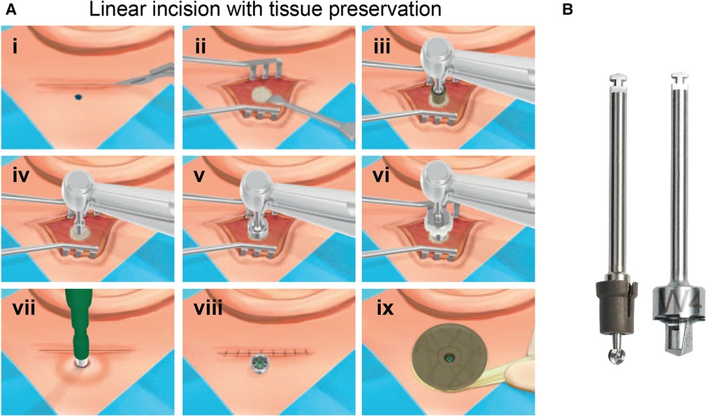 A minimally invasive surgical approach for the treatment of