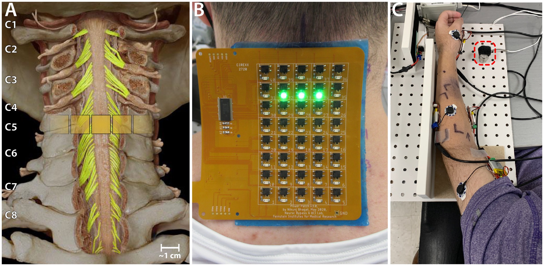 Spinal Cord Stimulation, CorTec