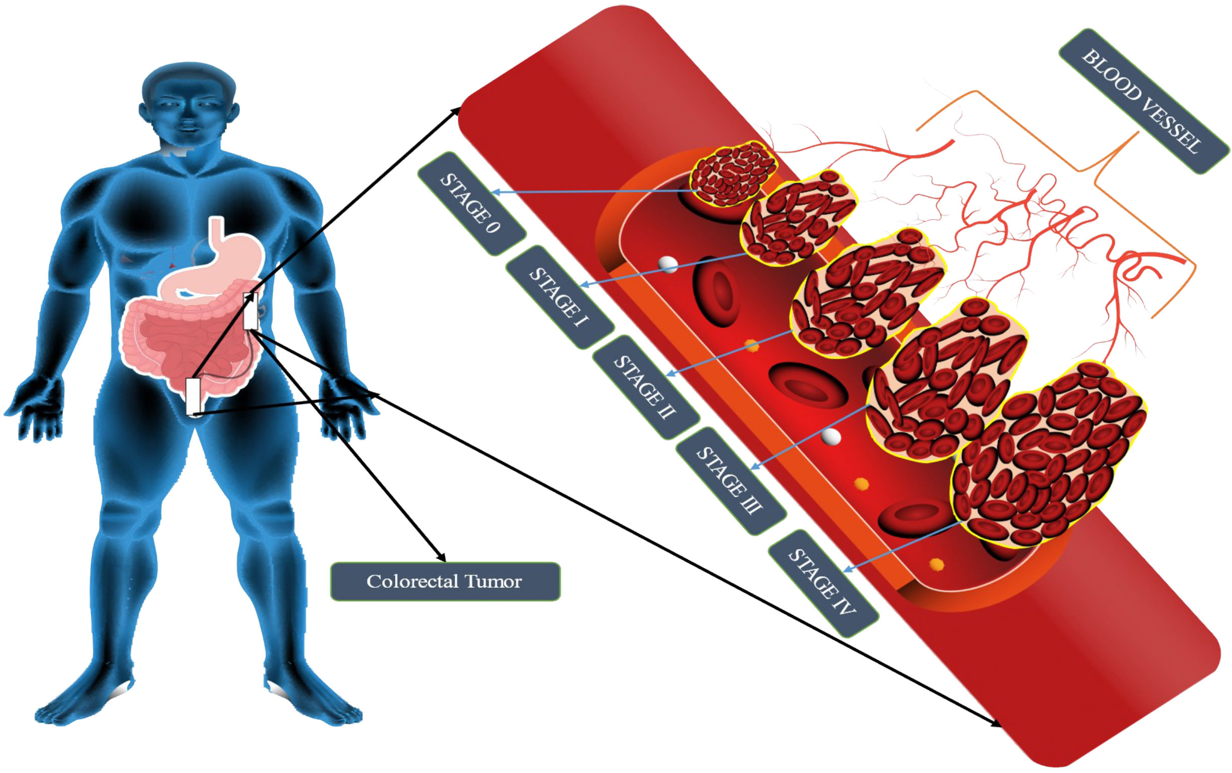 colon cancer stage 0