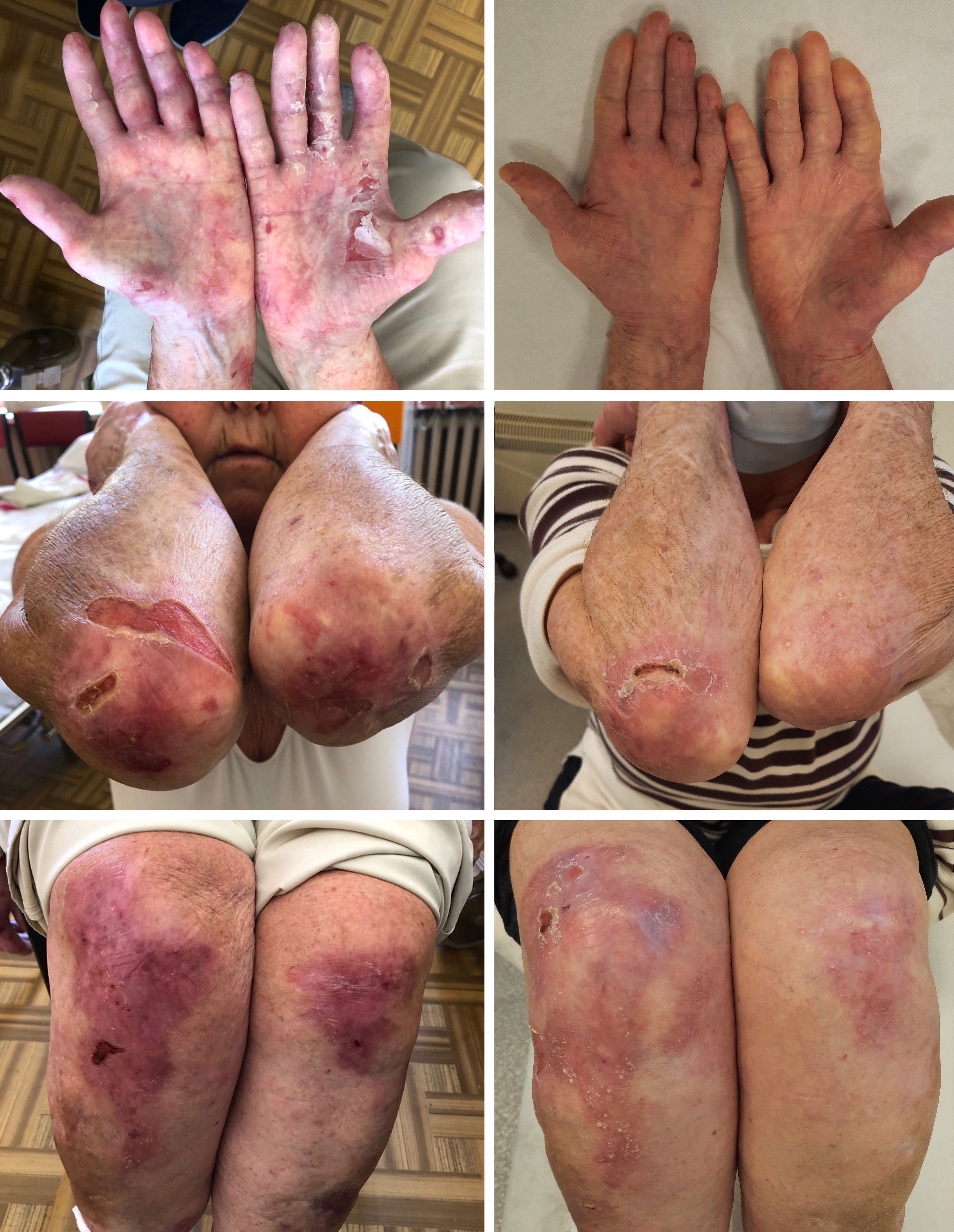 Frontiers  Epidermolysis Bullosa Acquisita: The 2019 Update