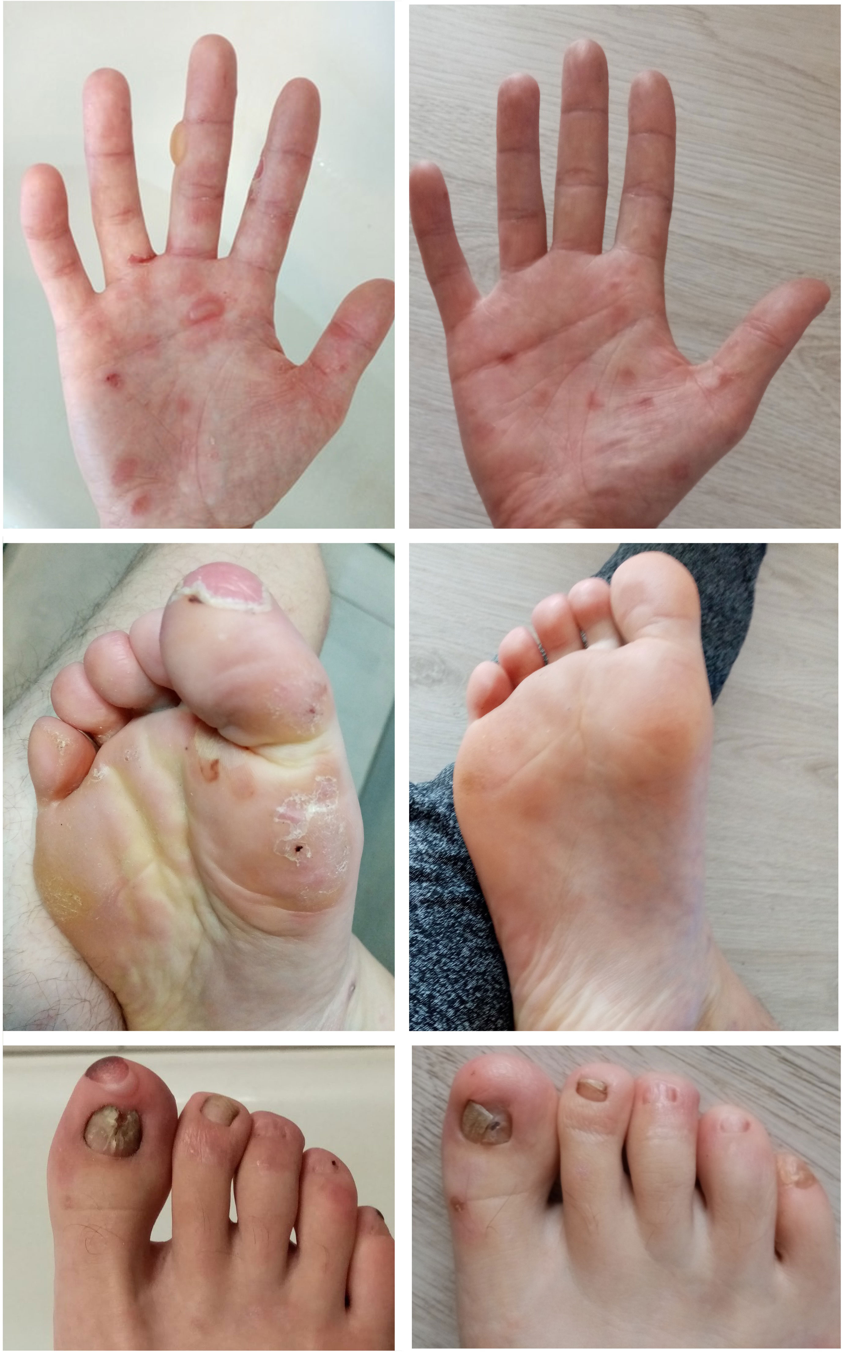 Frontiers  Epidermolysis Bullosa Acquisita: The 2019 Update