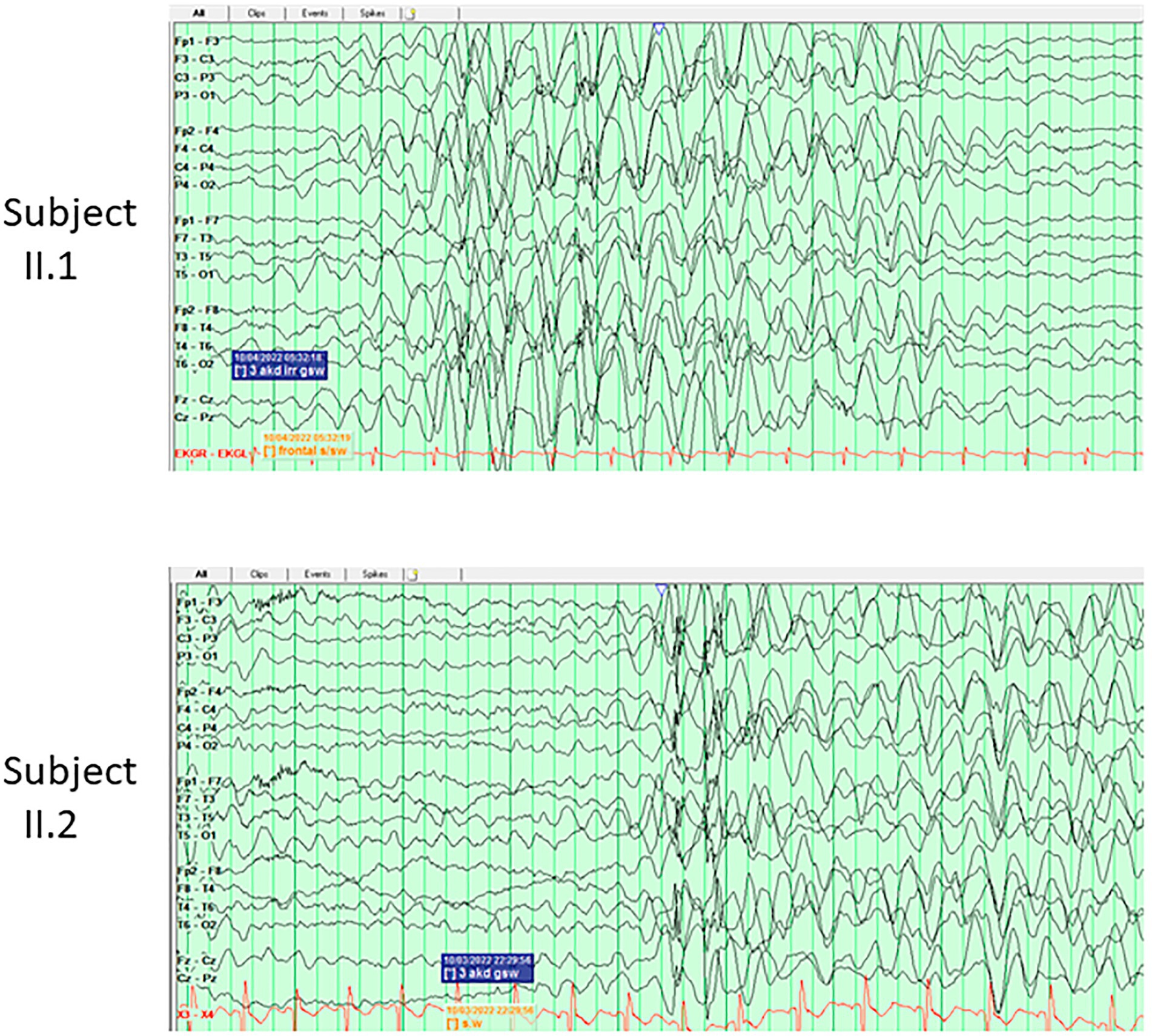 Frontiers  Intrafamilial variability in SLC6A1-related neurodevelopmental  disorders