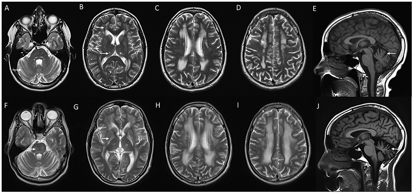 Frontiers | Adult-onset leukodystrophies: a practical guide, recent ...