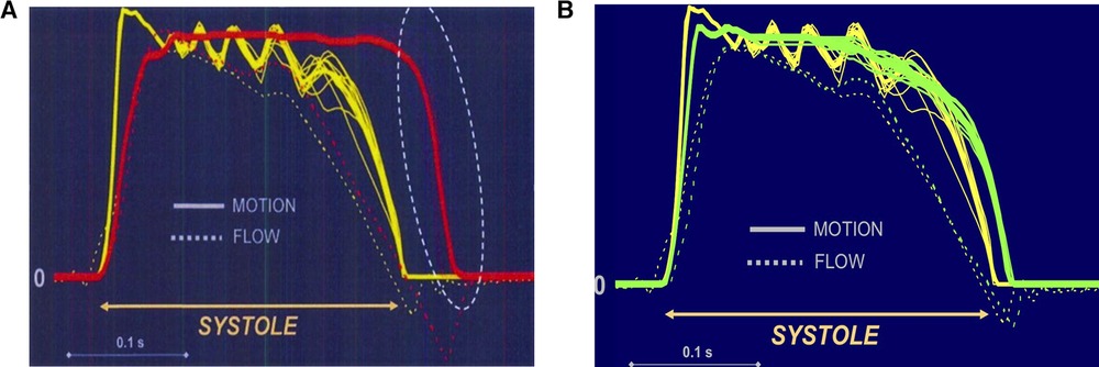 On-X versus St Jude Medical Regent mechanical aortic valve prostheses:  early haemodynamics