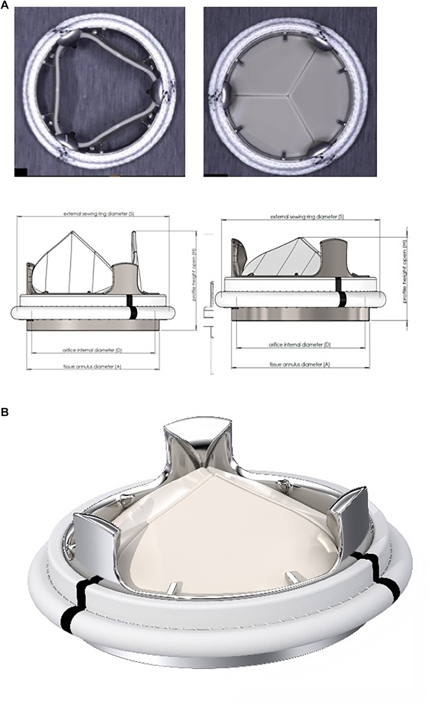On-X versus St Jude Medical Regent mechanical aortic valve prostheses:  early haemodynamics