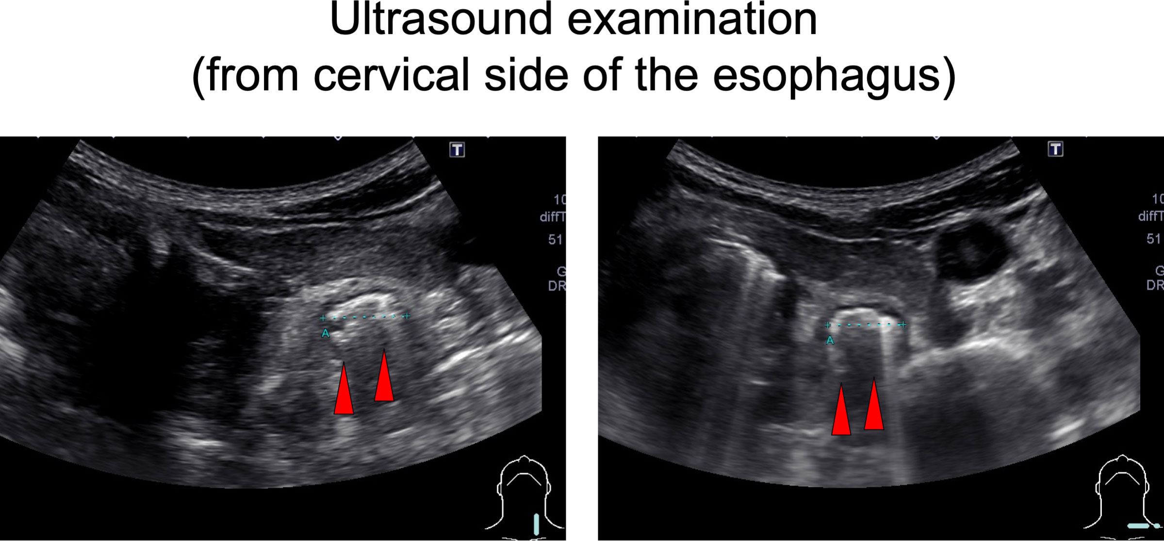 Frontiers | Case Report: Repeated esophageal obstruction in a patient ...