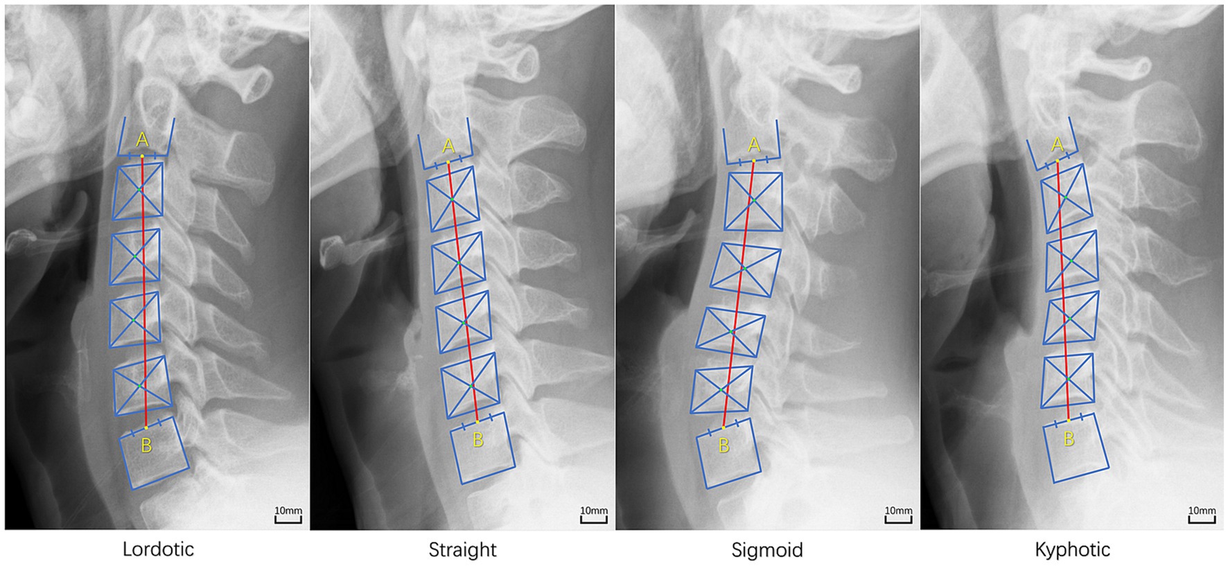 Frontiers  Prevalence and risk factors of occupational neck pain in  Chinese male fighter pilots: a cross-sectional study based on questionnaire  and cervical sagittal alignment