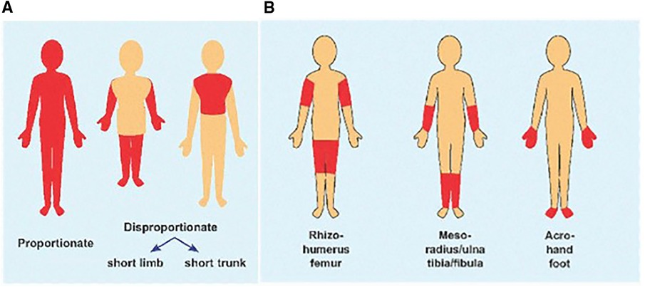 hypochondroplasia symptoms