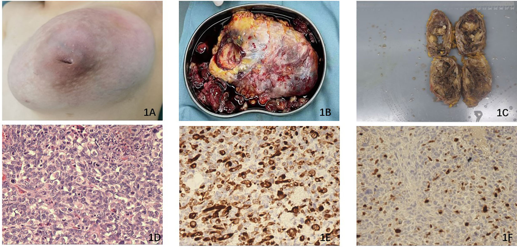 Frontiers | Case Report: A 13-year-old adolescent diagnosed as ...