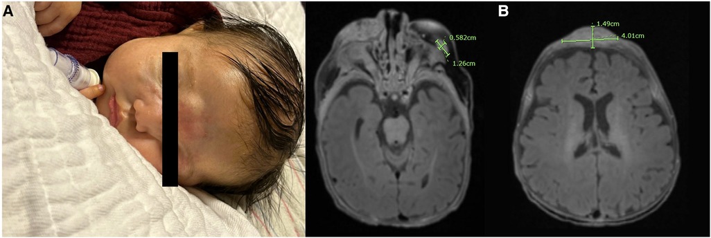 Frontiers | An unusual presentation of neonatal rhabdomyosarcoma: a