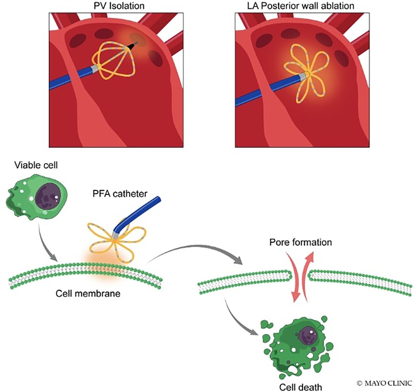 Impact of sex on clinical, procedural characteristics and outcomes of  catheter ablation for ventricular arrhythmias according to underlying heart  disease