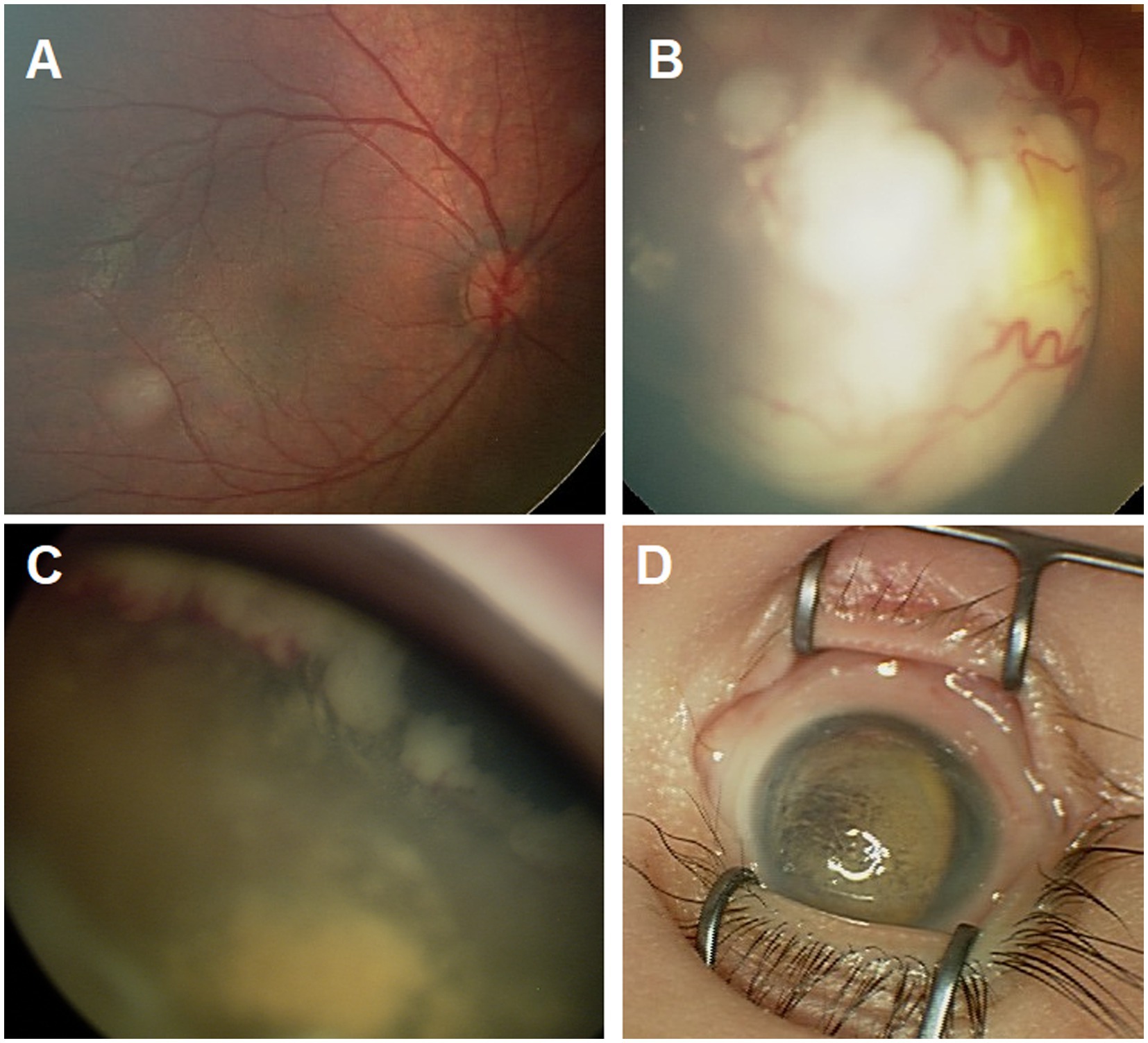 Retinoblastoma Treatment - NCI