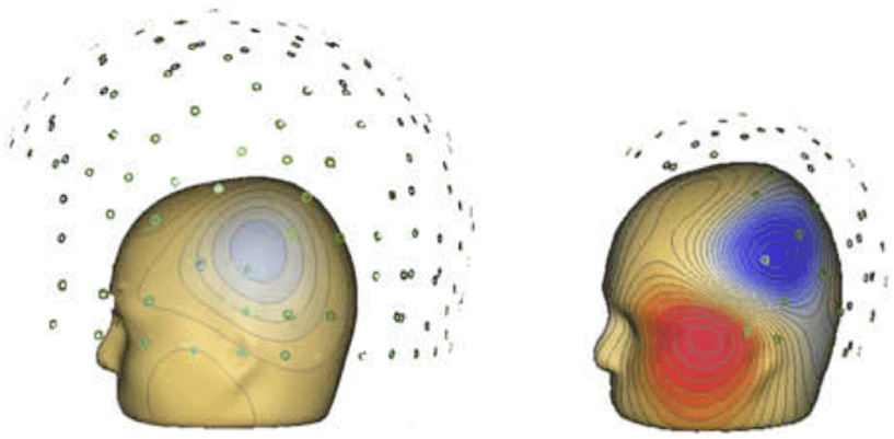 Figure 4 - On the left is a child’s head in an adult MEG helmet.