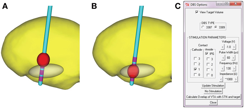Figure 2 - A model for the effect of electrical stimulation in a patient's brain.