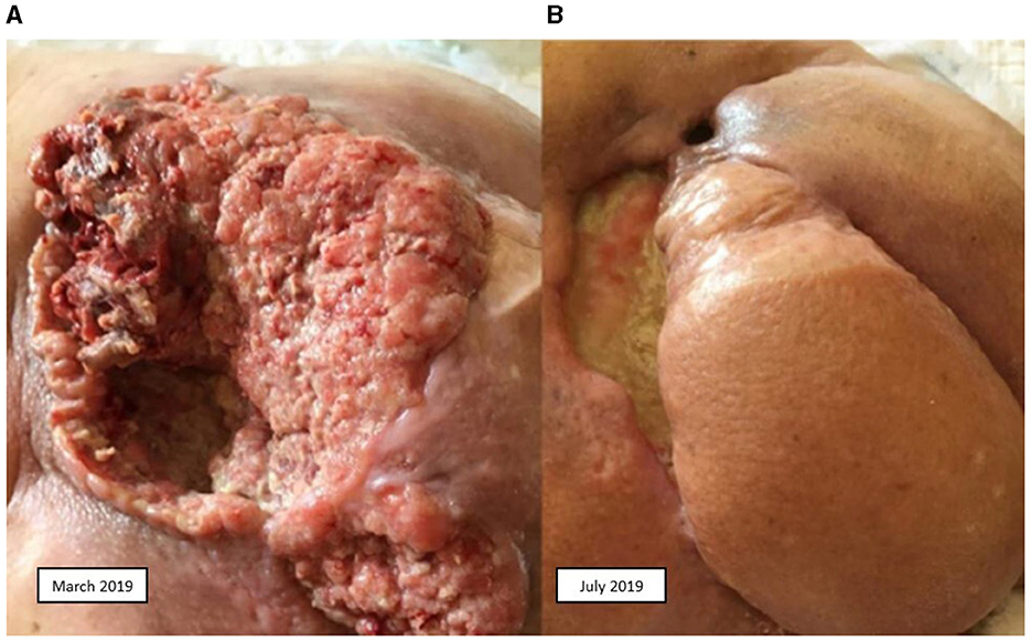 Squamous cell carcinoma over pilonidal chronic disease. A new therapeutic  approach - ScienceDirect