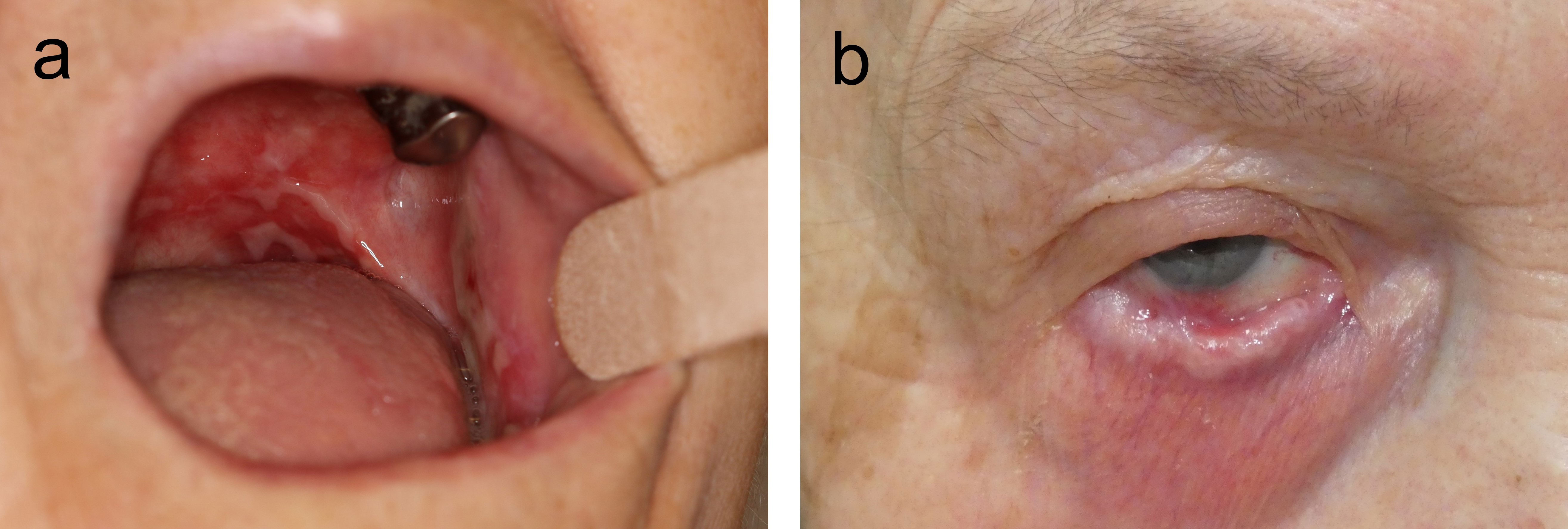 A 7-year retrospective study of biopsied oral lesions in 460