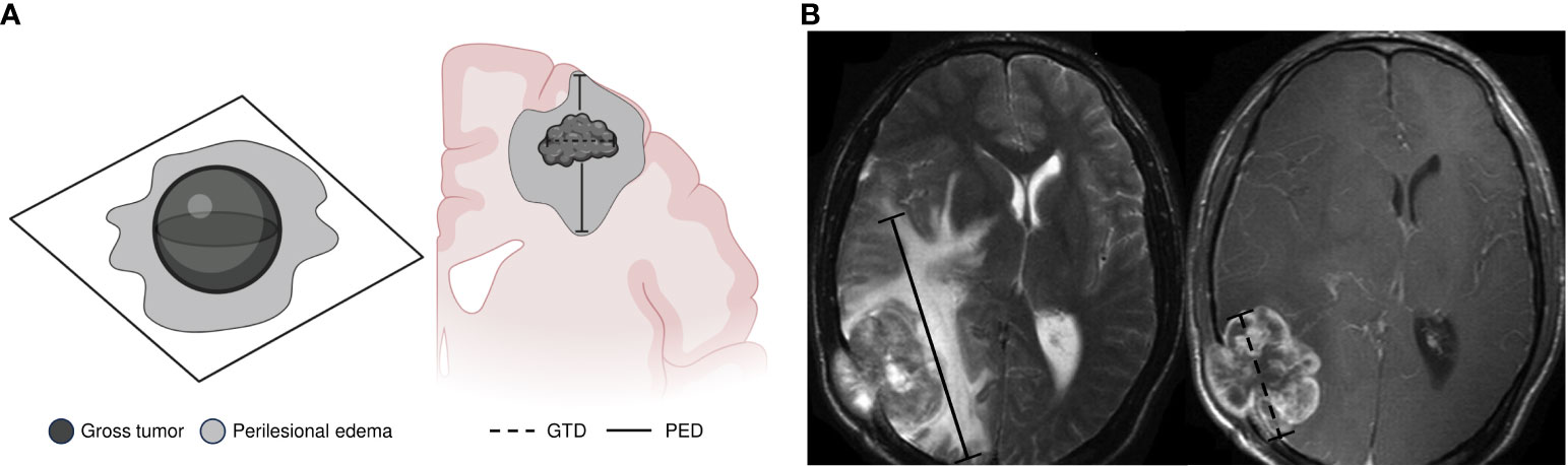 Frontiers | Perilesional edema diameter associated with brain metastases as  a predictive factor of response to radiotherapy in non-small cell lung  cancer