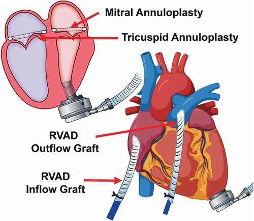 Frontiers  Case report: Facilitating right heart recovery after