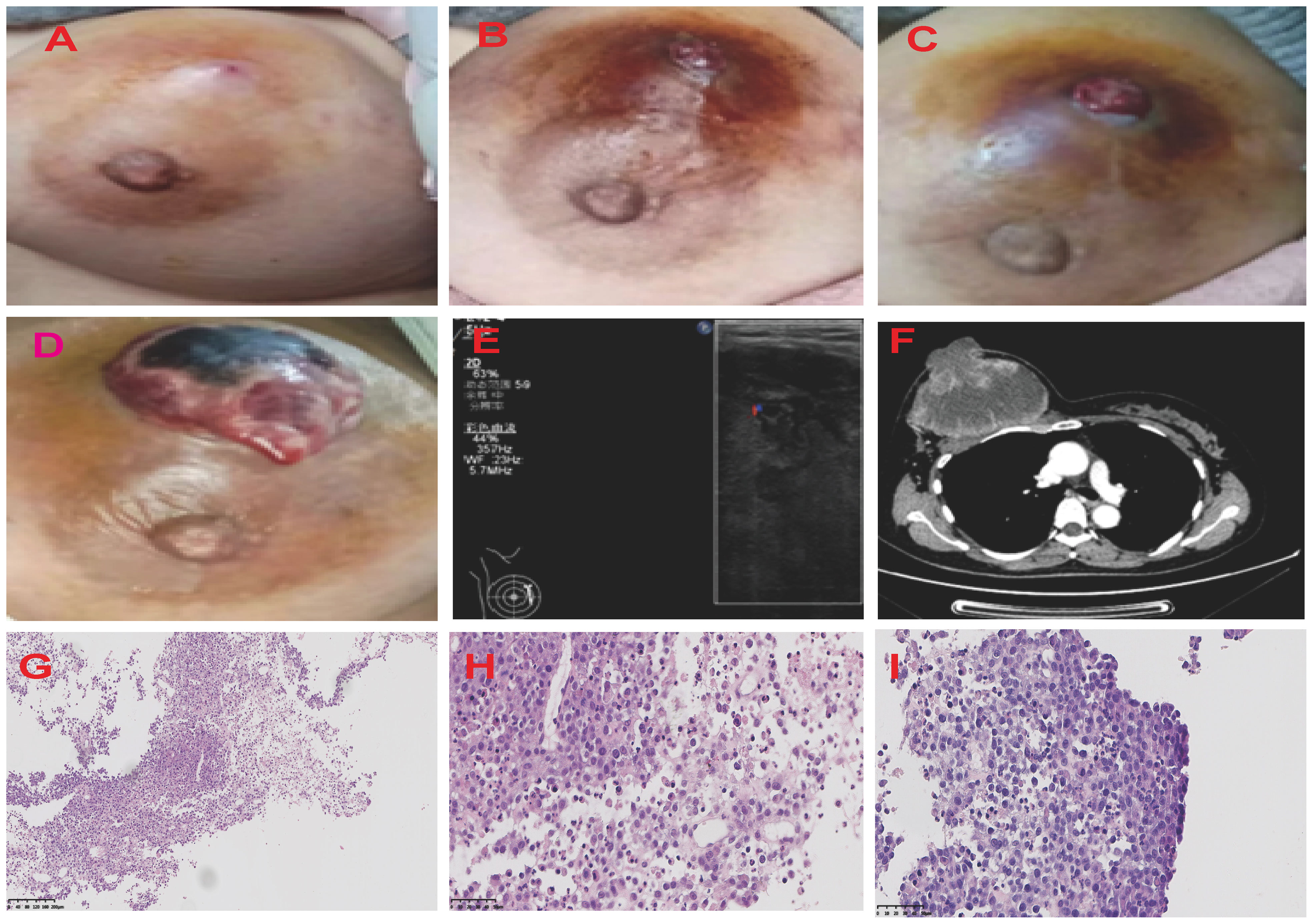 PDF) Necrotizing Cutaneous Fungal Infection of the Breast in a