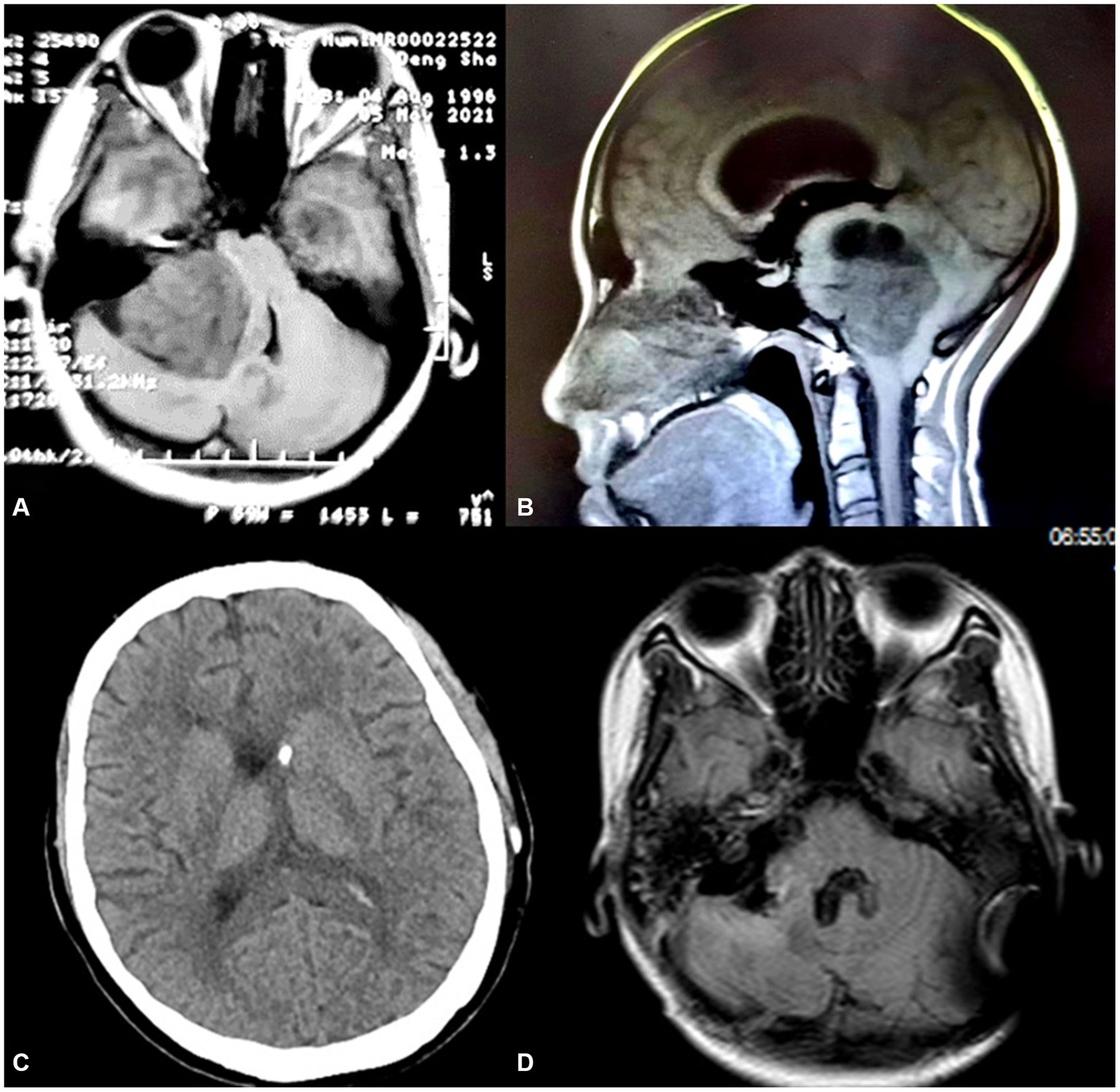 2023 Neurofibromatosis Type 2 Clinic Overview Mayo Clinic check you