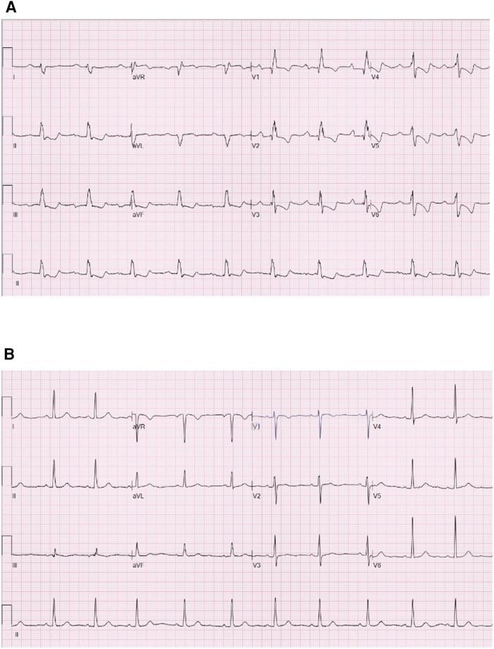 Crochetage' sign on ECG in secundum ASD: clinical significance