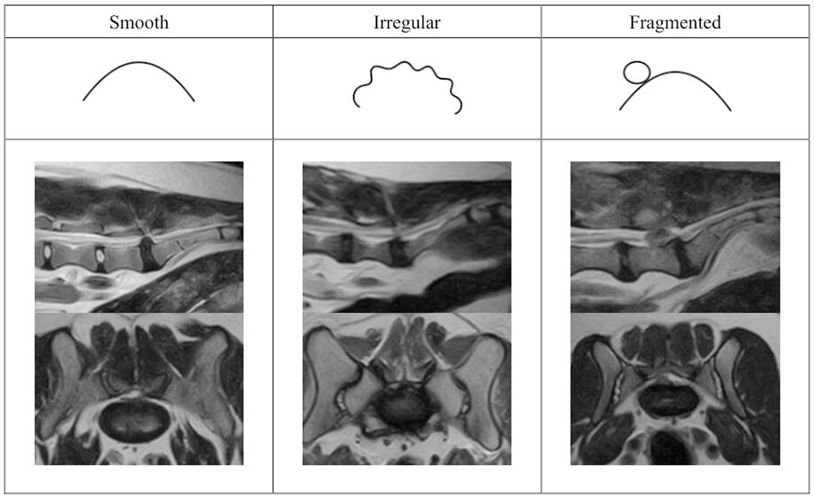 Lumbar spinal stenosis (grading), Radiology Reference Article