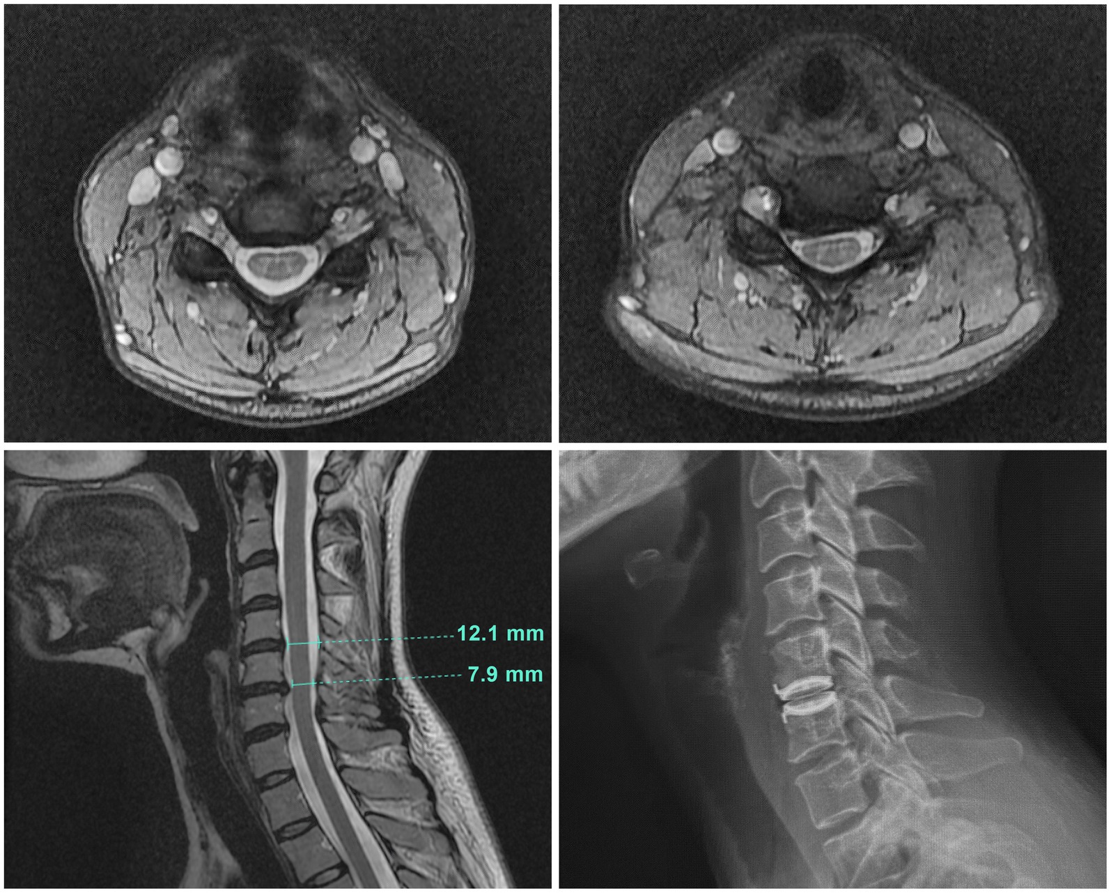 Myelopathy  Johns Hopkins Medicine