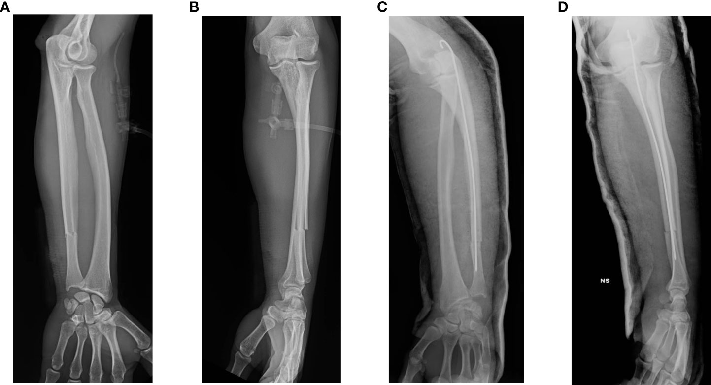 Ultrasound Bone Stimulator Accelerates Clinical and Radiographic