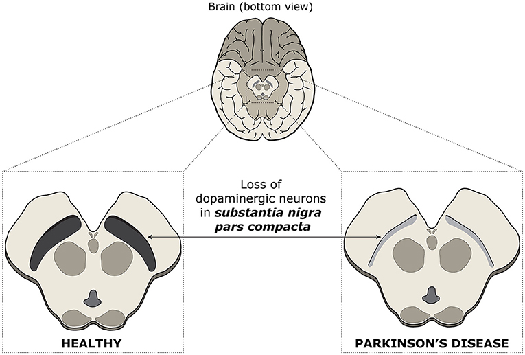 Figure 2 - Spotting differences in healthy and Parkinson’s disease brains.