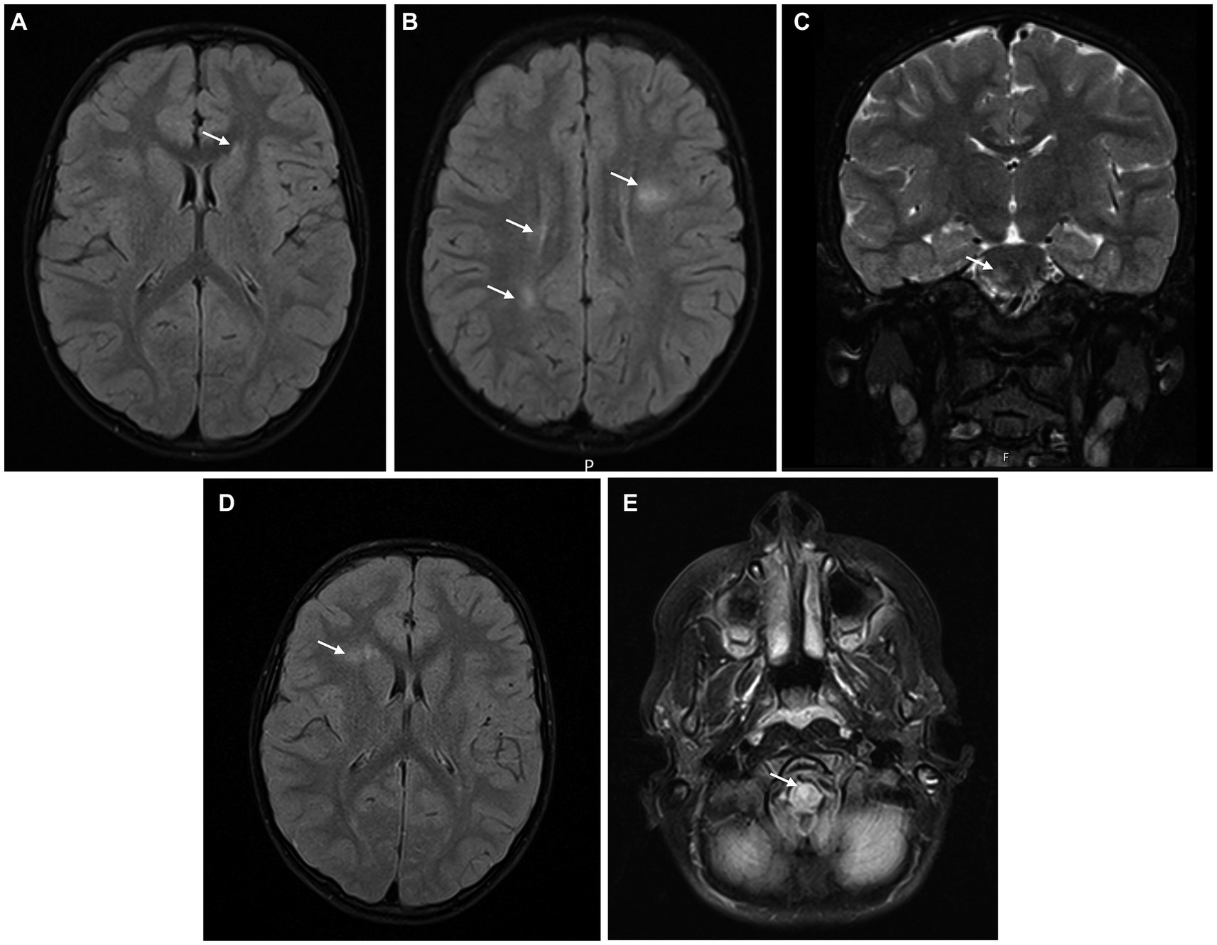 Frontiers | Multiple sclerosis under the age of ten: the challenge of a ...