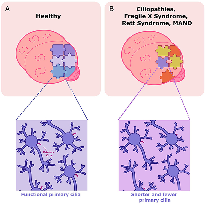 Figure 3 - (A) In a healthy brain, each brain cell has a functional primary cilium and the brain cells come together properly, completing the “puzzle”.