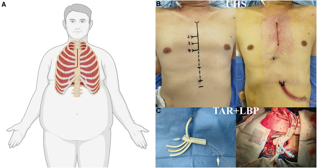 Frontiers | Obesity and acute type A aortic dissection